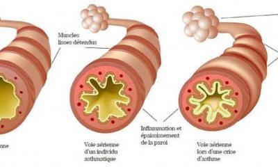 Asthme et asthme sévère : actualités et perspectives en 2025